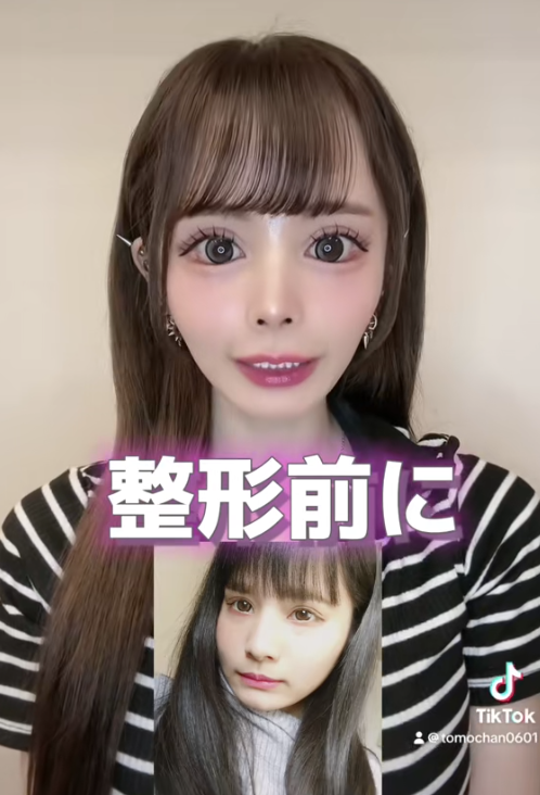 うんとも 整形前